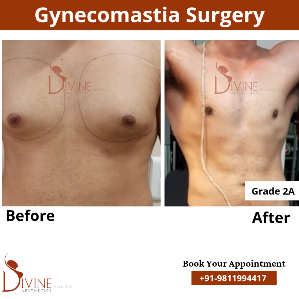 gynecomastia surgery