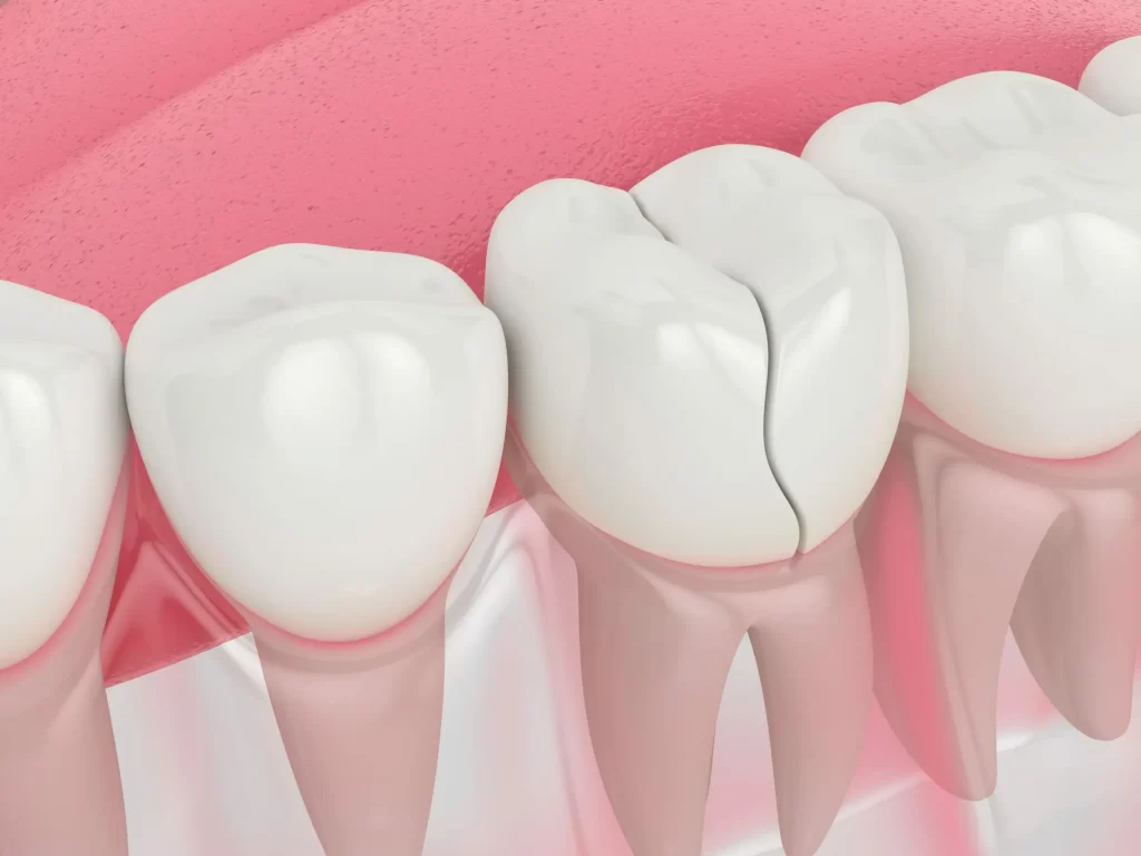 root canal cracked tooth